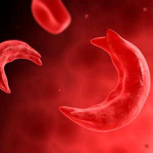 فقر الدم المنجلي جمعية الأمل لمكافحة السرطان